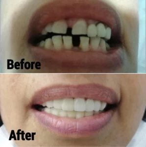 Dentist Kusadasi Turkey Before and After Image
