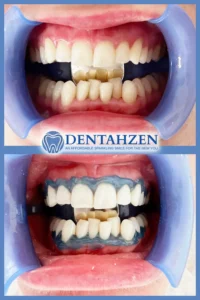 Teeth Whitening In Kusadasi Turkey