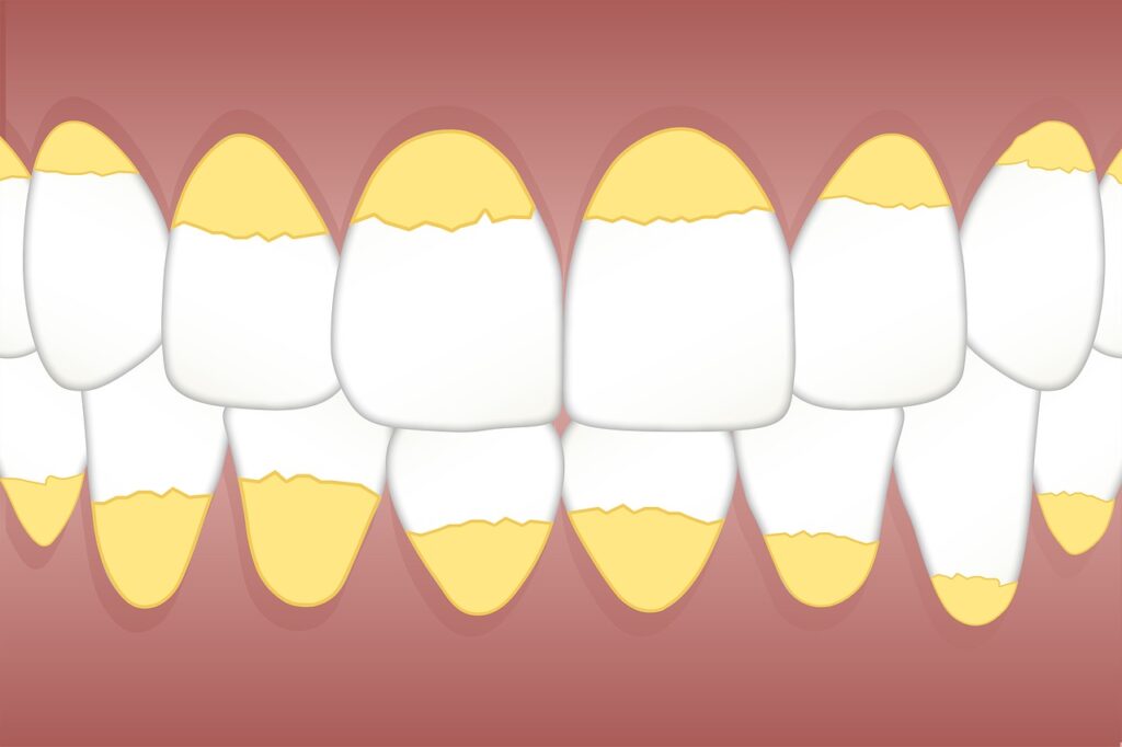 Teeth Whitening for Older Adults - Impact of Aging on Tooth Color