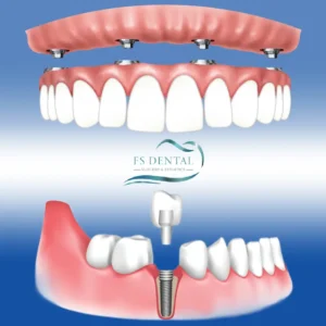 Dental Implants Surgery Process Kusadasi Turkey
