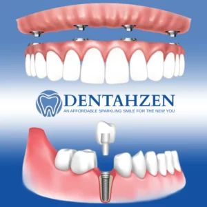 Dental Implants Surgery Process Kusadasi Turkey
