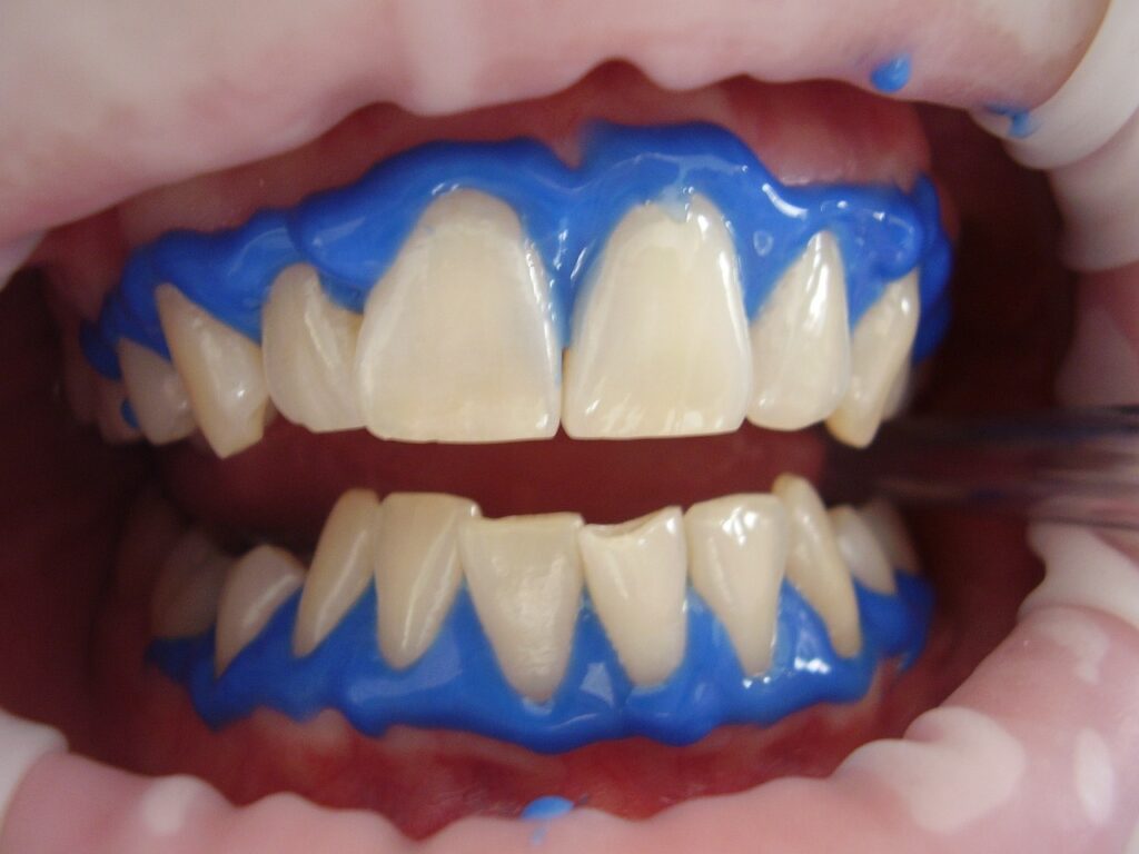Teeth whitening for dental restorations