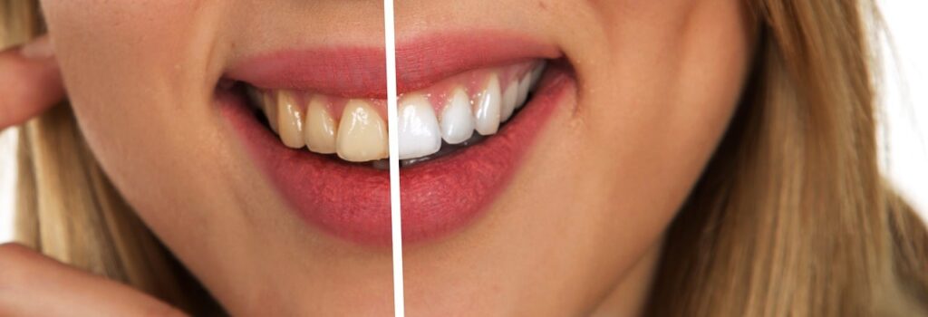 Teeth Whitening Kusadasi Turkey - Before and After