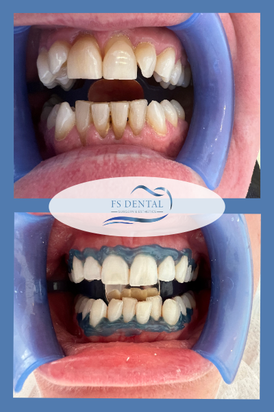 Teeth Whitening In Kusadasi Turkey Before and After